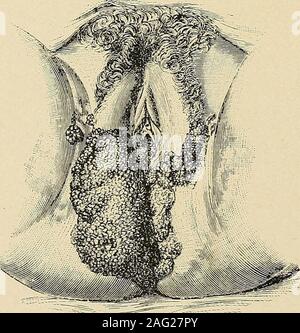 . Le diagnostic et le traitement des maladies des femmes. Fig. 258. Petites masses de condylomata.Gynécologie.) (Gi a,irL-pratique. Banque D'Images