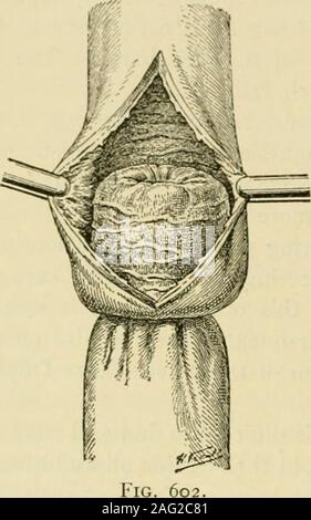 . Manuel de chirurgie opératoire. ssaire pour ouvrir l'intestin grêle, Paul préfère les ananastomosis parce qu'il y a des objections à ces a décidé une fistule fécales con-connecté avec l'intestin grêle, et généralement, ces perspectives favorables pour courtcircuit dans cette situation, que le supplément de risque immédiat peut être acceptedunless paresis et effondrement ont déjà pris le dessus, lorsqu'un isimperative anus artificiel. Si l'obstruction complète est connu pour être dans le gros intestin le tc distal * cette évacuation n'est pas toujours nécessaire. Cela devrait être fait onlj si grande que la distension de l'OSSI gut va Banque D'Images
