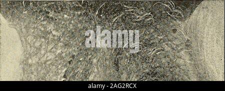 . Le diagnostic et le traitement des maladies de la femme. ll le rein travail effectué par le rein droit.un rare et intéressant sous forme de croissance est le retroperitoneallipoma rétropéritonéal, ^^qui a généralement son origine dans les zones péri-rénale La graisse. Diagnostic gynécologique 170 V Il peut fortement évoluer dans des directions différentes et, dans certains cas, devenir si largethat il remplit le ventre, poussant les intestins de côté ou de les aplatir sur itssurface. Edward Reynolds, de Boston, a fait état d'une tumeur très étendu de thiskind. La taille et l'emplacement de la masse et de la Zone de matité à la percussion par areshown fig. Banque D'Images