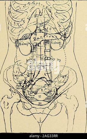 . Le diagnostic et le traitement des maladies des femmes. Fig. 178. Pour palper la tendresse ou une masse dans le UmbilicalRegion. u. Banque D'Images