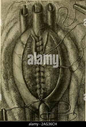 . Manuel de chirurgie opératoire. sur inweak les patients quand les colliers ne sont pas utilisés. Quand a lieu l'hémorragie de l'itis ligne de suture postérieure du tractus gastro-jéjunostomie. Unir l'estomac pour le jéjunum pour une distance d'environ 2 pouces par arow de sutures matelas exactement comme dans l'anastomose latérale intestinale (posteriorserous suture). Faire une incision parallèle et plus court que le posteriorserous suture, à travers toutes les couches de l'estomac à l'exception de la muqueuse. La partie postérieure de la muqueuse GASTRO-ENTEROSTOMY 369 moues maintenant jusqu'à la plaie. Faire une incision dans thejejunum correspondante. Introduire un bu Banque D'Images