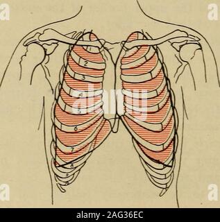 . Diagnostic médical pour l'étudiant et le praticien. Fig. 106.-Normal.résonance apex Kronigs méthode. Fig. &Gt;7.-rétracté apex gauche.Kronigs méthode.. Banque D'Images