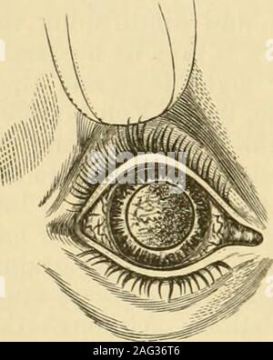 . Un traité sur les maladies de l'oeil. ope, les détails de la croissance peuvent bebeautifully vu. Au début, la maladie estlimitée à une partie de la rétine, qui becomesopaque, épaissie, et quelque peu en apparence marbrée-ap. La croissance morbide augmenteselon progressivement étendue et l'importance, jusqu'à ce qu'elle dépasse la forme d'un blanc jaunâtre masse nodulées dansle corps vitré. Selon Virchow, la Von Ammon.] Augmentation de la taille de la tumeur est due en partie à la croissance de la masse initiale, et en partie pour theformation de nouveaux foyers de la maladie dans son voisinage ; en conséquence, sur becomin Banque D'Images