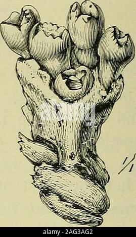 . Les tumeurs, malignes et innocentes ; leurs caractères cliniques et le traitement approprié. Fig. 291.-Cluster de dents de l'ovaire intégré dans l'os. Banque D'Images