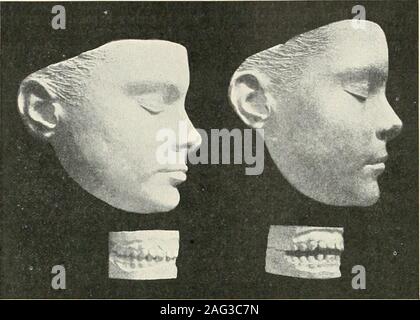 . La science et la pratique de la chirurgie dentaire. L'exaltation de l'arcades dentaires toone l'autre. Fonction de traitement de la malocclusion peut seulement prononcé de la proéminence traditionnelles aboutissent à des dents ou l'inverse (ex-usuallythe), et l'affichent-ance le patient doit être lesspleasing hadlieen que si le cas laissés seuls tout à fait. Ce([uestion vill être considérés comme inmore détail en rapport avec différentes variétés de malocclusion antéro-postérieur ; mais ineach la variété même ofproblem présente souvent elle-même,à savoir, ^^•restorenormal sans occlusion q ue pour consultation à des considérations otlier,ou si Banque D'Images