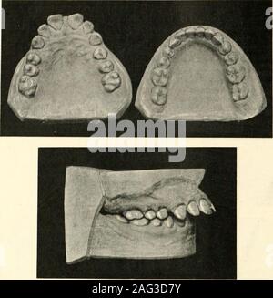 . La science et la pratique de la chirurgie dentaire. shouldapply esprits de vin deux fois par jour pour le driedsurfaces des dents. De cette façon, la douleur-plénitude du processus est réduite au minimum et thedeposition de dentine secondaire est encouragée.Si nécessaire les molaires supérieures devraient être devital-isée. Si le degré d'ouverture est si grande que tion, et une certaine quantité de meuler la ata date ultérieure s'probablv permettent de vaincre la maladie. (S'infiltrer. 244, et des figues. 371, 372, 374.) Il a été dit ci-dessus que de nombreux cas ofopen-cas sont associés à des végétations adénoïdes, enlargedtonsils, et la sténose nasale. Ces cours de conditionsof Banque D'Images