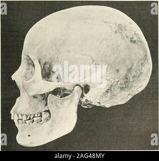 . La science et la pratique de la chirurgie dentaire. opedarches, et l'attrition marquée des dents. (La moitié de la taille naturelle.) {Musée du Stirgeons EiuiUind RoyalCollege de de.) de faits utiles, dès asmeans devisedfor ont été la mesure exacte. L'jiroblemto considérer est : Comme-supposant que pour le bien ofargument com-paratively que la petite taille des thejaws dayis à l'heure actuelle une inlierited inwhat la qualité, ainsi que l'diminu-tion s'expliquer ? A Muclidisctission centeredround thepossibility la question de de l'hériter de acquis le CCRVSI-ters, c'est à dire, d'acharacte Banque D'Images