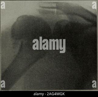 . Un manuel d'exercice thérapeutique et massage, conçues pour l'usage des médecins, des étudiants et de l'ion masseurs. les muscles des épaules ; toute irritation par exercisewill nmscular la cause des spasmes, ce qui représente une contre-indication à l'exercice d'autres à l'angle d'spasmtakes place. Il se peut que le spasme musculaire empêche anymotion du tout, mais cette condition ne devrait pas être confusedwith la fixation musculaire volontaire. De plus, si le traitement a été effectué sur des fonds suffi-samment douceur au cours des jours précédents le patient est la règle, de l'AAS, suffisamment formés pour comprendre la d Banque D'Images