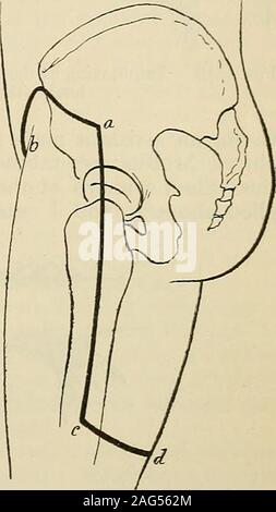 . La chirurgie moderne, général et du dispositif. Fig. 1076.-Macewens compressionof méthode de l'aorte abdominale (texte américain-bookof chirurgie). Fig. 1077.-postérieure cas inhabituel requiringhip inauthors rabat-amputation mixte : a-b. Theanterior incision ; a-c-d, l'ex-incision externe et le début de la coupe postérieure. cas, la compression situé de manière échoue à intercepter le sang-courant dans un certain nombre de navires oflarge. Diverses autres méthodes ont été employées. C'était autrefois le customto comprimer l'aorte abdominale au moyen d'un compresseur (Fig. 1074, 1075).Un tourniquet est très probable d'être déplacées Banque D'Images