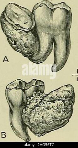 . Les tumeurs, malignes et innocentes ; leurs caractères cliniques et le traitement approprié. Fig. 125.-Ossific ball dans lequel les racines de deux molaires sont intégrés.La couronne d'une dent cariée, est une tumeur, l'ensemble ; B, à la section. [JIuseum de la Middlesex. Sospital) odontomes radiculaire ont été observées dans la marmotte, le porc-épic, l'agouti, et le sanglier (Figs. 127, 128), et des éléphants. Il est très probable que beaucoup, peut-être la plupart, des racines de défenses dans thesethickened les verrats et les éléphants et le. Banque D'Images