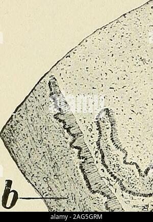 . Pathologie gynécologique ; un manuel de technique microscopique et au diagnostic dans la pratique gynécologique, pour les étudiants et les médecins. ccept ce plan, pour toutes les différents titres seulement la confusion. À mon avis, il est inutile, quand de la formation d'adhérences entre le 134 SALPINGITE PURULENTE. Plis simule des glandes, ce nom à l'état microscopique, salpingitisfollicnlaris ou, ce qui est mieux, pseudofollicularis. En outre, nous hearof Salpingite isthmica noueuse, chronica, productiva vegetans tialis disseminata-intersti, parenchymatosa pachysalpingitis chronica, un-na Banque D'Images