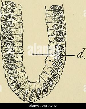 . Pathologie gynécologique ; un manuel de technique microscopique et au diagnostic dans la pratique gynécologique, pour les étudiants et les médecins. Son latterdoes les tissus ne sont pas touchés pas, mais réagit avec une petite infiltration unicellulaires.Il y a ensuite de nombreuses cellules lymphoïdes dans le tissu interstitiel, whichtake la lutte contre le cancer. De cette façon, il est clearthat une décision peut être très difficile si le tissu conjonctif pour someother raison (inflammation) est déjà infiltrés de cellules rondes.alors la forme régulière des cellules épithéliales qui décide. Un carcinomatousor néoplasme sarcomateux-in ne Banque D'Images