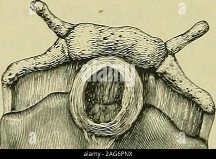 . Les tumeurs, malignes et innocentes ; leurs caractères cliniques et le traitement approprié. 6 parathjrroid INTEOBUGTION au corps. C'était probablement une grande para-thyroïde. On sait peu de choses de ces organes particuliers quand thisspecimen est venu à part en 1886. La capsule était composé ofdense laminse de tissu fibreux ; la tumeur pourrait avoir des beeneasily sa capsule de énucléés. Les exemples précédents montrent que les tumeurs bénignes classedas ou innocents ne sont que de dangereux lorsque leur. Banque D'Images