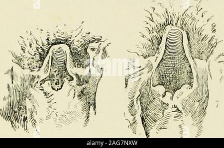 . Les maladies de l'enfance et l'enfance : conçu pour l'utilisation d'étudiants et de praticiens de la médecine. Fig. 82.-Méthode de raccordement de l'avant dans l'épiglotte intubation.. Banque D'Images