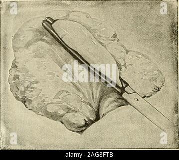. La chirurgie moderne, général et du dispositif. Fig. 758.-Fowlers Méthode de la gastro-enterostomy. Fig. 759.--Moynihans forgastric humide et opérations intestinales(faites par les Frères, Londres). Artère colique moyenne, récupérer un peu de la surface des mesocolonby une paire de pinces hémostatiques, retirez-la de la partie postérieure de l'stomachwall, et ouvrir le sac du péritoine moindre par les ciseaux. Agrandir l'theopening par la dilatation ou la déchirure jusqu'à ce qu'il admet trois doigts. Inspecter la paroi gastrique postérieure andfeel. Placez l'estomac dans sa position naturelle,marque avec le pouce le plus bas de la partie postérieure de l'er Banque D'Images