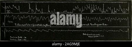 . Materia Medica : pharmacologie, thérapeutique et de prescription écrit pour les étudiants et les praticiens. ally grave, est une des causes les plus fréquentes d'oflack de l'indemnisation, et peut être le précurseur d'ventricularfibrillation et la mort. DIGITALIS l6l (c) dans le cœur est une tachycardie paroxystique ou nearlyso régulièrement, mais très rapide, le taux étant généralement de plus de 150. Le beatsmay ont leur origine dans l'oreillette, dans le ventricule, ou theauriculoventricular au noeud. Tachycardial originateat si le bat le auriculoventricular noeud, il est vrai, un rythme nodal et l'oreillette et le ventricule recevoir t Banque D'Images