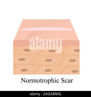 Normotrophic cicatrices. La structure anatomique de la cicatrice de la peau. Vector illustration sur fond isolé. Illustration de Vecteur