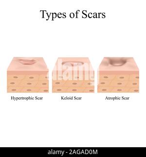 Types de cicatrices. Les cicatrices d'acné. , Chéloïdes, hypertrophiques, normotrophic atrophique. La structure anatomique de la peau avec l'acné. Vector illustration Illustration de Vecteur