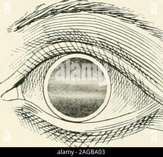 . La réfraction et la façon de réfracter : y compris des sections sur l'optique, la rétinoscopie, le montage de lunettes et les lunettes, etc.. obscurci par zones de ténèbres,qui rendent extrêmement difficile l'étude de la réfraction, et l'observateur devra changer sa distance répétez-edly pour trouver des espaces comme à proximité du centre de l'pupilas possible, comme c'est cette partie de la zone pupillaire que le patient va voir à travers lorsque l'effet mydriatic. passesaway L'kinetoscopic photo obtenue par themirror moing de manière à décrire un cercle à la périphérie de l'espace de diagnostic est tout à fait thepupillary Banque D'Images