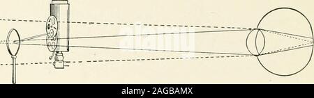 . La réfraction et la façon de réfracter : y compris des sections sur l'optique, la rétinoscopie, le montage de lunettes et les lunettes, etc.. plus rapide dans onemeridian que dans le méridien à angle droit. L'astig-matism est dans le méridien d'un mouvement lent. La différence apparente entre l'avion et con-cave miroir dans la direction de l'retinalillumination moxement d.-avec le miroir plan les rayons de lumière sont.reflétée comme s'ils provenaient d'un point juste jusqu'à 164 de réfraction ET COMMENT SE RÉFRACTENT. le miroir comme la source originale de Hght est en face d'elle.Les chirurgiens eye derrière un miroir plan est, Banque D'Images