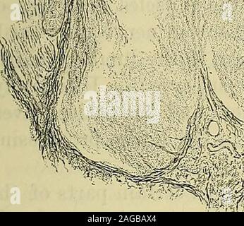 . Un manuel des maladies du système nerveux. e largeveins dans cette situation. Il y a habituellement qu'une petite extravasationsin la pie-mère. Le cordon est, dans la plupart des cas, meurtri et compressedby le fragment inférieur (Fig. 87). Parfois, c'est aplati, et il peut même être divisé, nerf-toutes les substances qui sont évincés de thepia-gaine matral à l'endroit. Dans le cas illustré Fig. 85 et 86le cordon semble avoir été divisée longitudinalement à l'endroit, par-pad par la vigueur de la commotion. Il est très courant de havelocal myélite, en face de la fracture, sans aucune annonce narrowingof e Banque D'Images