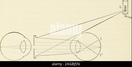 . La réfraction et la façon de réfracter : y compris des sections sur l'optique, la rétinoscopie, le montage de lunettes et les lunettes, etc.. ^ emmetropiceyes avec l'hébergement au repos. Figure 8i montre des theposition la lumière, L, l'ophthalmoscope, le examinersand l'œil examiné dans ces conditions. La divergence des rayons x à partir de la lumière (L) se reflètent con-. FiG. 8i. vergently du miroir concave, et l'accent dans le vitré-ous, ils se croisent et forment une zone d'éclairage sur theretina au SI. La rétine, située à l'accent principal du média, dioptrique projets naturellement de son indi-vi Banque D'Images