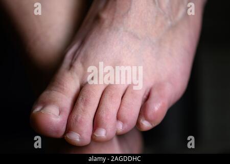 Close up of shamed femme cachant son altlete pied de la maladie. Pieds Smelly weaty porteur d'une maladie infectieuse Banque D'Images