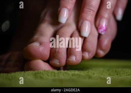 Femme sur le dessus des pieds avec des champignons. La récupération après la macération de la peau en raison de tinea pedis Banque D'Images