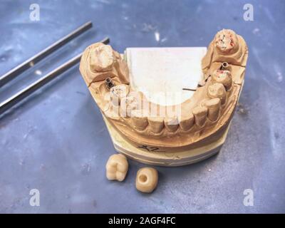 Metal cast borne de dent sur un modèle 3D en laboratoire. Affûté et poli modèle dent dentaire sur la construction métallique. Le modèle de la mâchoire humaine avec l'im Banque D'Images