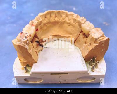 Metal cast borne de dent sur un modèle 3D en laboratoire. Affûté et poli modèle dent dentaire sur la construction métallique. Le modèle de la mâchoire humaine avec l'im Banque D'Images