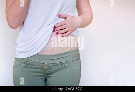 Sac de colostomie de couleur de peau attaché à jeune femme patient. Gros plan sur poche de stomie après chirurgie du côlon. Thème médical. Traitement du cancer du côlon Banque D'Images