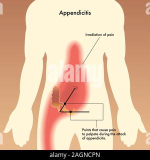 Illustration médicale montrant les points qui causent la douleur à la palpation lors de l'attaque de l'appendicite. Banque D'Images