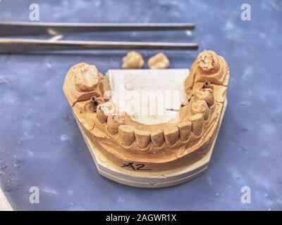 Prothèse dentaire en semiprocess. Test de la dent artificielle, prothèse dentaire moderne fait main implantat céramique. Le dentier, de fausses dents. Banque D'Images