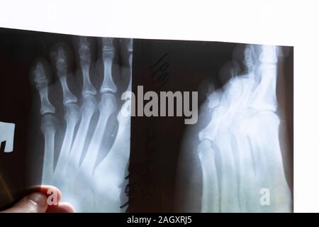 Jambe cassée. X-ray image montre une fracture fermée de la jambe gauche. Banque D'Images