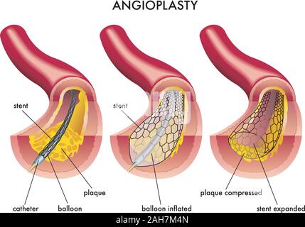 Illustration médicale d'une opération d'angioplastie. Illustration de Vecteur