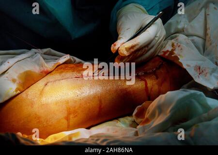 Patient sur incision chirurgicale en salle d'opération réelle de travail de l'équipe de chirurgiens Banque D'Images