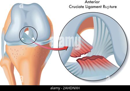 Illustration médicale de rupture du ligament croisé antérieur. Illustration de Vecteur