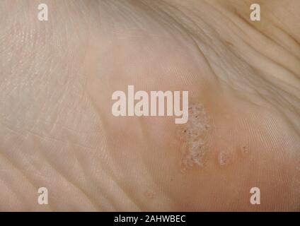 Gros plan sur une verrue plantaire sur le fond d'un talon pied causée par le virus du papillome humain, ou VPH. Banque D'Images