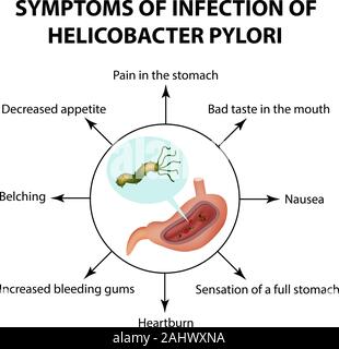 Symptômes d'infection de l'Helicobacter pylori. L'infographie. Vector illustration sur fond isolé Illustration de Vecteur