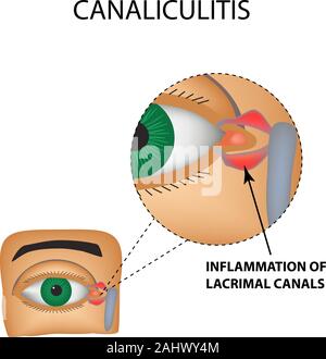 Canaliculitis. L'inflammation des canaux lacrymal. La structure de l'œil. L'infographie. Vector illustration sur fond isolé Illustration de Vecteur