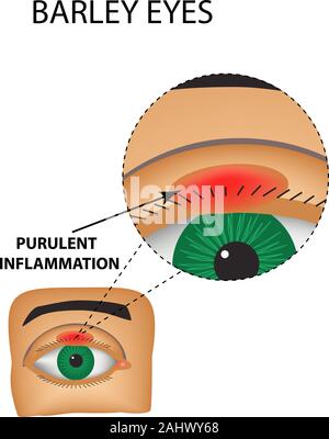 Les yeux de l'orge. L'inflammation purulente. La structure de l'œil. L'infographie. Vector illustration sur fond isolé Illustration de Vecteur