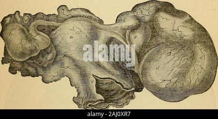La pathologie et le traitement des maladies des ovaires : (en cours de l'essai pour l'Hastings 1873).. . 59 d'ingéniosité dans son traitement, sans aucun bénéfice, et fromFebruary jusqu'en août, 1"80, nous avons effectué plus d'treatmentequally en vain. 3d août j'ai ouvert l'abdomen, andfound les ovaires grand, adhérent complètement dans le cul-de-sac,couvert de la lymphe, et d'avoir les infundibula du tubesoccluded. Les tubes ont augmenté dans de grands kystes, chaque contenant de quatre à cinq onces de sérum clair. Le organshad à être très soigneusement détachée, comme les adhésions furent ex-trêmement ferme, et l'il Banque D'Images