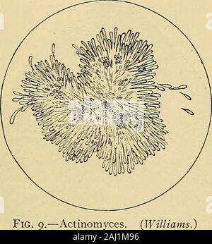 Les méthodes de diagnostic, chimiques, bactériologiques et de microscopie : un texte-livre pour les étudiants et les praticiens . g bacilles. Ces organismes tache byGrams méthode ainsi que l'ordinaire avec des colorants d'aniline. Pour un diagnostic final-sis inoculation sur un cochon d'Inde doit être faite. f.../j ^ ?..•• Tôles II. ){Arharme Hill Streptococcus pyrogenes (bleu de méthylène tache.) L'expectoration. 27 (m). L'Actinomycose Hominis (Ray champignon). Ce champignon, qui donne lieu à la condition connue sous le nom de mâchoire grumeleuse chez les bovins, l'homme, causant parfois infecte conditions pulmonaires tuber culosis ressemblant à. L'expectoration muco Banque D'Images