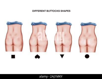 Illustration de taut muscles fessiers. avant et après les traitements ou d'adaptation Banque D'Images