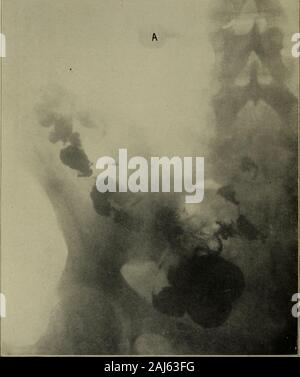 Opérations de la chirurgie gynécologique et du sud de l'Association . Fig. 2.-Roentgenogram mis vingt-quatre heures après l'ingestion de repas thebarium encore, montrant la rétention dans le diverticule (A). Banque D'Images