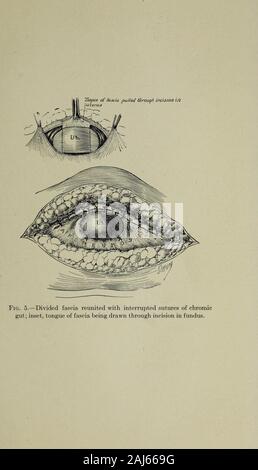 Opérations de la chirurgie gynécologique et du sud de l'Association . Fig. 4.-muscles Rectus a réuni, grâce à l'incision du fascia langue;fundus split de rabat supérieur ; un rapport, de l'incision pour uterinecavity.. Banque D'Images