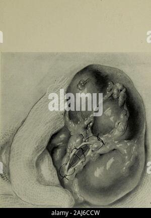 Opérations de la chirurgie gynécologique et du sud de l'Association . Fig. 2.-montre l'exposé de pierre et d'être extrait avec de longues pinces,spécialement conçue à cet effet.. Fig. 3.-montre la pierre extraite, points séparés placés et étalonnages prêts être attachés. Remarque, en particulier, que ces sutures n'incluent pas le mucousmembrane. Banque D'Images