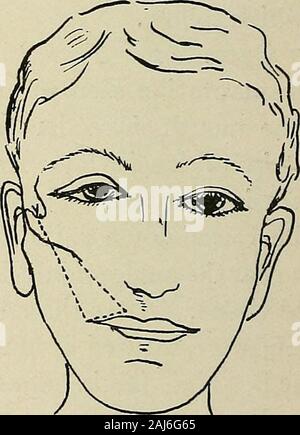 La chirurgie plastique ; ses principes et pratiques . J'ai 2 cochon. 703.-l'utilisation d'une boucle de fil métallique pour augmenter l'angle de la bouche dans la paralysie faciale.(Momburg).-i. La position du fil passé par une perforation dans le zygomaticarch (Busch). 2. La position du fil passée au-dessus de l'Arcade zygomatique (Momburg). Dans l'ensemble de ces méthodes où un tunnel à travers les tissus de la joue est nécessaire, il est recommandé de placer les doigts dans themouth, afin que les progrès de l'instrument peuvent befollowed tunneling et perforation de la muqueuse à éviter. Lawen a implanté des morceaux de l'os libre Banque D'Images