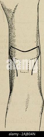 La chirurgie plastique ; ses principes et pratiques . Fig. S07.. Banque D'Images