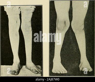 Un traité sur la chirurgie orthopédique . f le brevis et péroniers tertius. Le partsare doux tiré à part, le astragalonavicular areopened la cheville et mixte, et les pièces jointes à l'os naviculaire, et, dans la mesure possible, les personnes à la frontière intérieure et extérieure, sont divisés. Pied est ensuite adducted afin que le chef de l'os peut beseized avec des pinces et tiré vers le haut, la liga interosseous-ment et le ligament latéral interne ayant été divisé53 OBTEOFEDIC SUBGEBY 834. avec des ciseaux courbes, l'astragale est supprimé. Si après dépose de l'astragale la déformation ne peut pas être corrigée, être itshould Banque D'Images